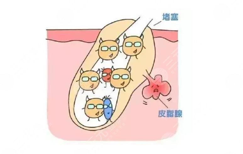 痘痘預(yù)防有哪些方法