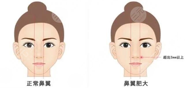 鼻頭縮小手術(shù)需要多少錢?