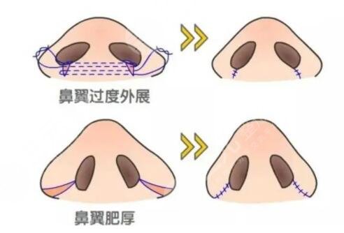 鼻頭縮小手術(shù)注意什么?