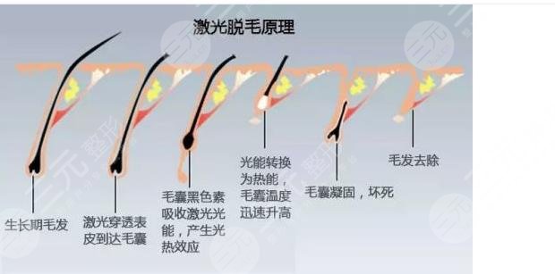 光子脫毛的危害