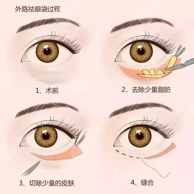 去除眼袋內(nèi)切好?還是外切好?