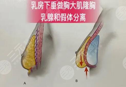 復(fù)合隆胸