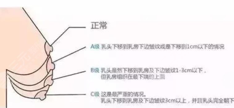 胸部整形