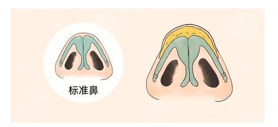 鼻頭縮小手術(shù)的?費(fèi)用大概是多少啊?