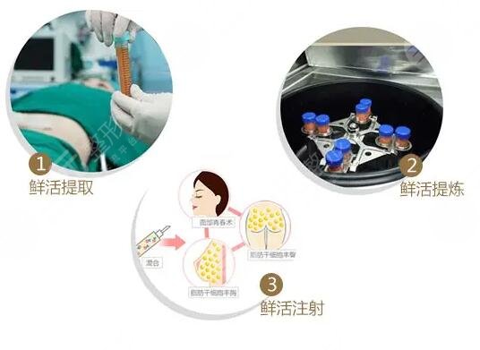 脂肪填充面部