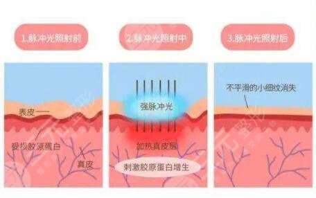 彩光嫩膚有副作用嗎?