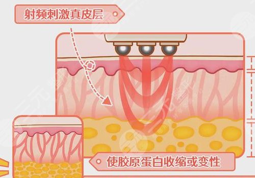 熱瑪吉全臉做一次多少錢？