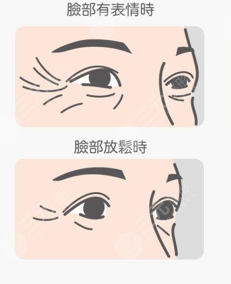 激光去魚尾紋徹底嗎?