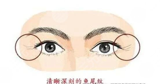 激光去魚尾紋徹底嗎?
