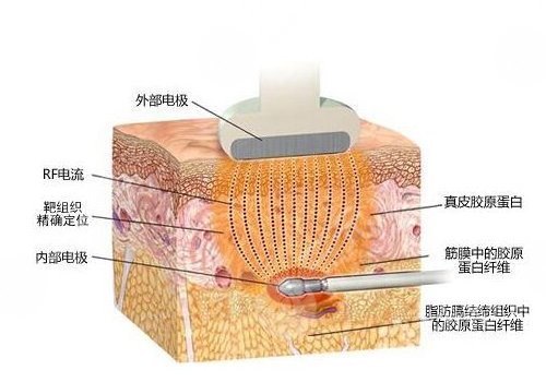 鐳射溶脂有效果嗎？