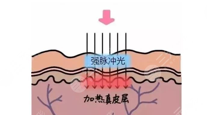 光子嫩膚祛斑效果怎么樣？幾次能徹底？會反彈嗎？