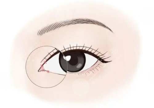開內(nèi)眼角一般多少錢？