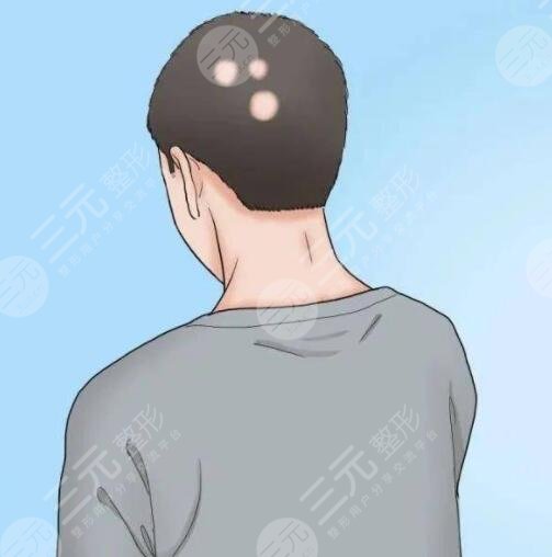 斑禿能治好嗎?