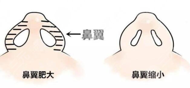 影響鼻翼縮小手術(shù)價(jià)格因素有哪些?