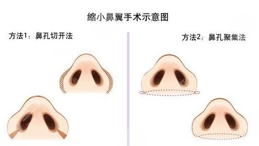 鼻翼縮小手術(shù)風(fēng)險(xiǎn)大嗎?