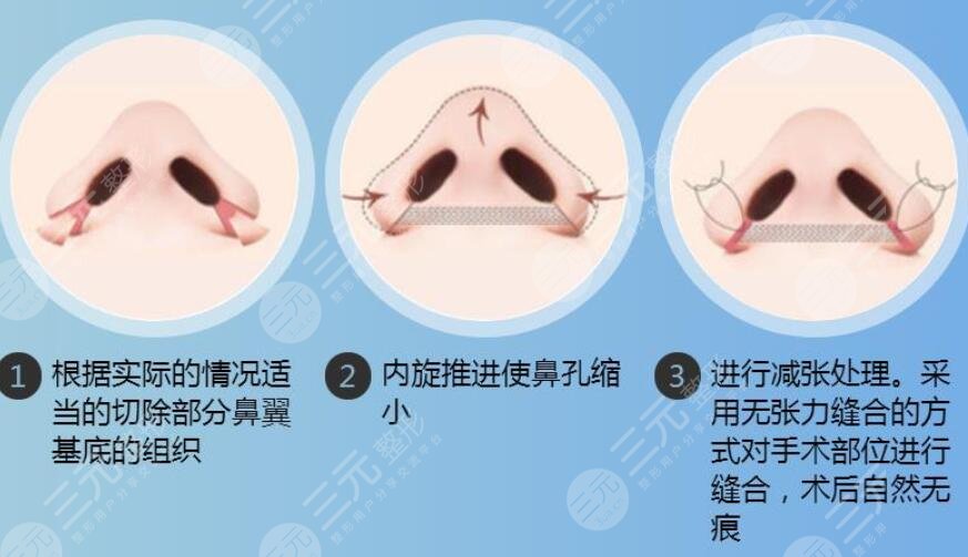 鼻翼縮小手術(shù)后如何護(hù)理?
