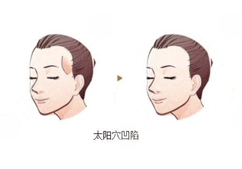 填充太陽凹陷脂肪能保持多久?