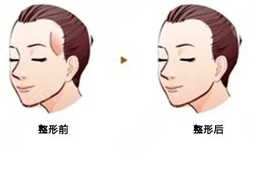 填充太陽凹陷脂肪能保持多久?