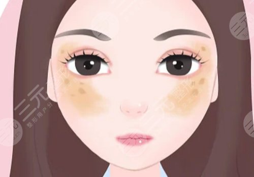 激光祛斑會(huì)不會(huì)反彈？需要做幾次？