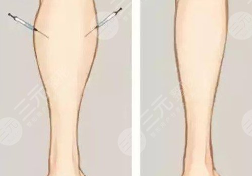 小腿吸脂后多久可以正常走路？