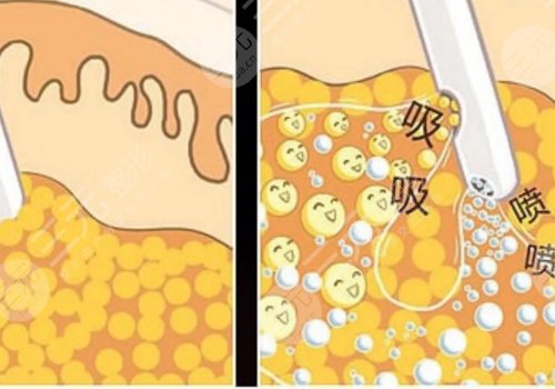 小腿吸脂后多久可以正常走路？