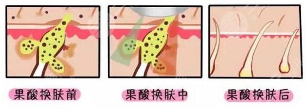 果酸換膚的適用人群
