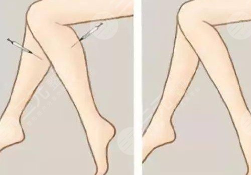 怎么快速瘦小腿？