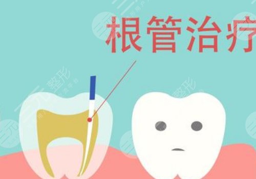 根管緩解一顆全部費(fèi)用