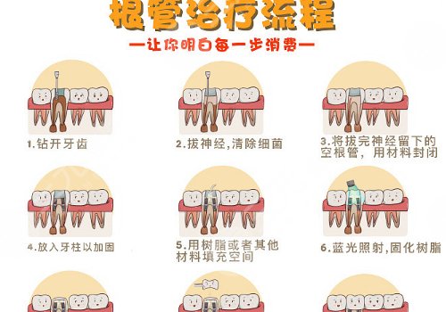 根管緩解一顆全部費(fèi)用