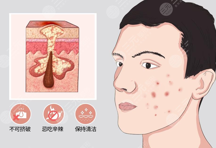 激光磨皮去痘印有效嗎?