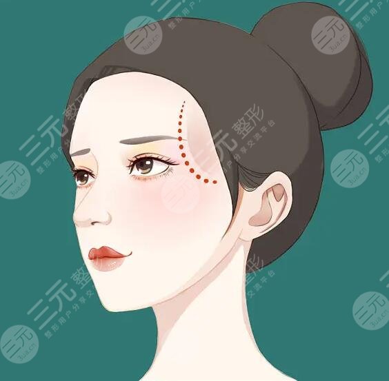 玻尿酸豐太陽(yáng)穴能保持多久？術(shù)后的注意事項(xiàng)有哪些？