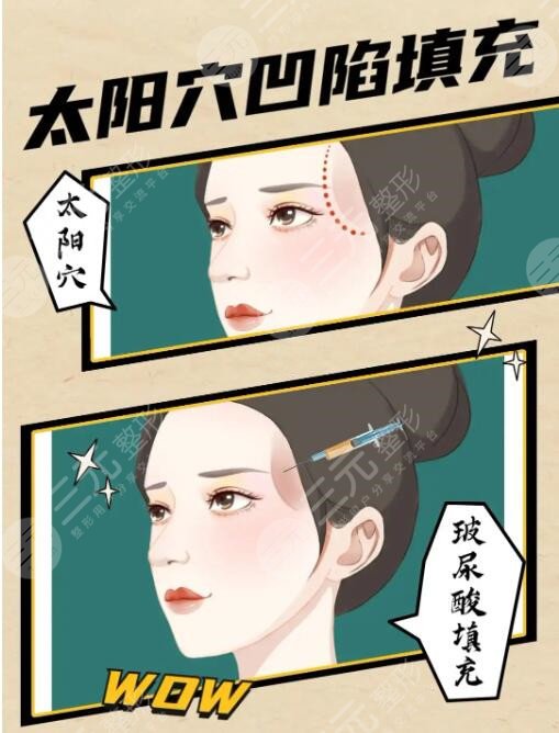 玻尿酸豐太陽(yáng)穴能保持多久？術(shù)后的注意事項(xiàng)有哪些？