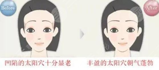 玻尿酸豐太陽(yáng)穴能保持多久？術(shù)后的注意事項(xiàng)有哪些？