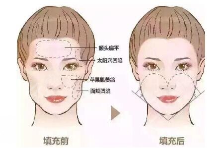 玻尿酸豐太陽(yáng)穴能保持多久？術(shù)后的注意事項(xiàng)有哪些？