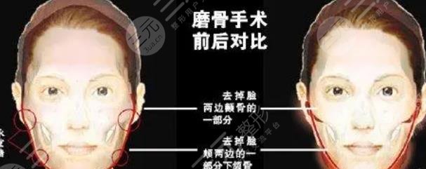 磨骨