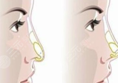 媽生鼻和直鼻微翹的區(qū)別是什么？