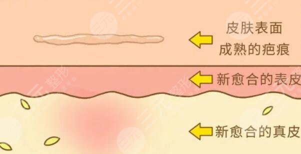 像素激光去疤痕要做多少次才會好?