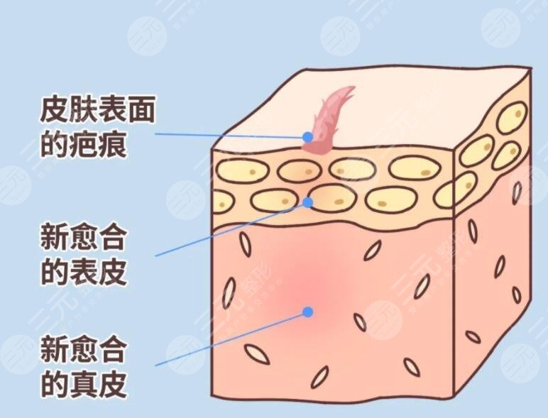 像素激光去疤術(shù)后注意事項