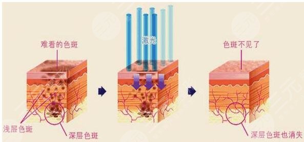 激光祛斑多少錢?