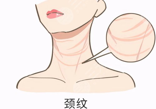 頸紋特別深怎么去除？