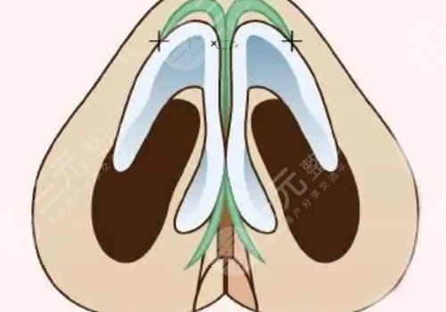 肋骨隆鼻肋骨取了對(duì)身體有影響嗎？