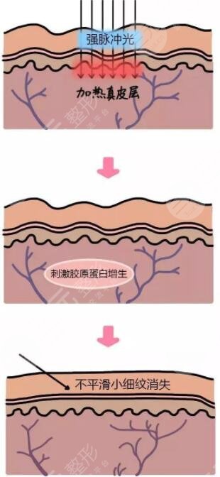 激光收縮毛孔有副作用嗎?