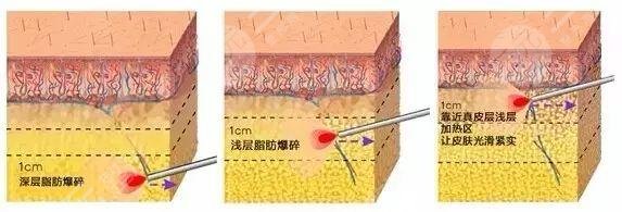瘦小腿的方法有哪些？