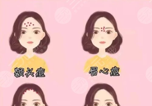 額頭長了很多密密麻麻的小痘痘是什么原因