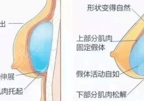 湖南雅美切雙眼皮好嗎?