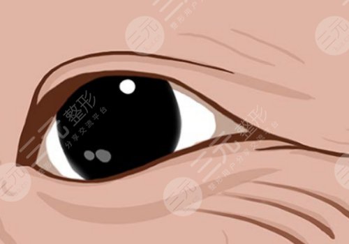 魚尾紋怎么才能去掉？