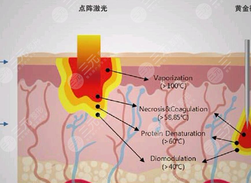 臉上的紅血絲是怎樣形成的?