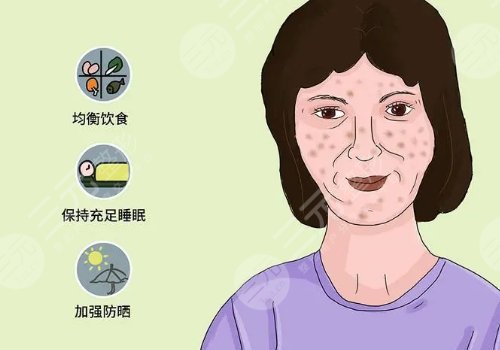 怎樣去除面部黃褐斑有效？