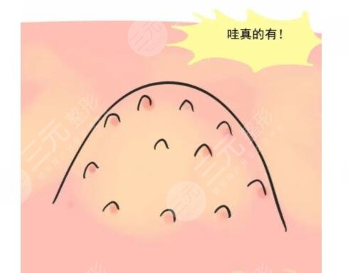 雞皮疙瘩是什么病?