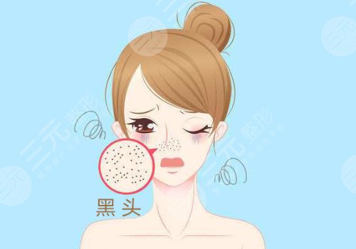 黑頭怎么去除有效？